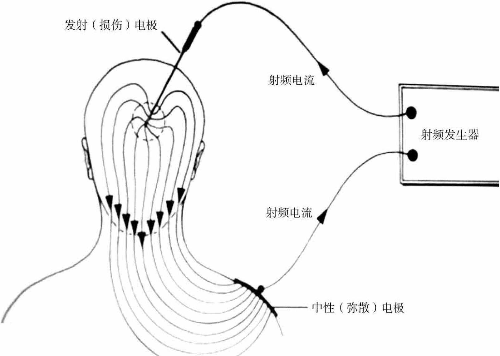 第三節(jié) 射頻鎮(zhèn)痛機(jī)制